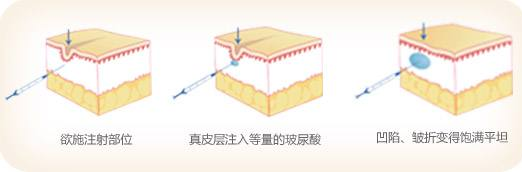 玻尿酸除皱原理