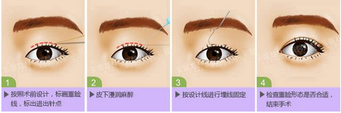 艺星埋线双眼皮原理