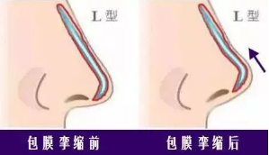 包膜的挛缩对比图