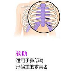 肋软骨隆鼻