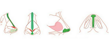 肋软骨隆鼻作用