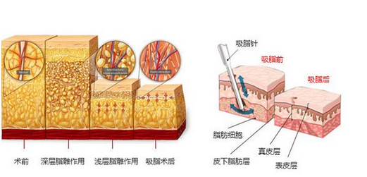 吸脂原理图示