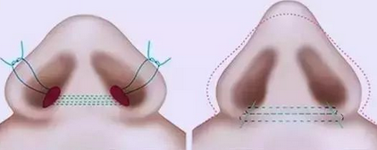 鼻翼肥厚整形