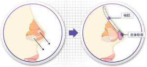 假体隆鼻