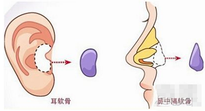 自体软骨隆鼻取材