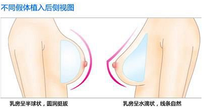 隆胸假体的突度决定效果