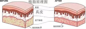 吸脂的原理示意图