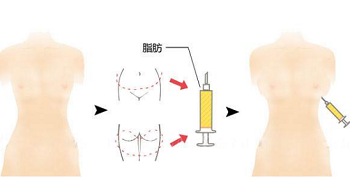 自体隆胸的原理过程