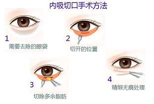 内切法去眼袋