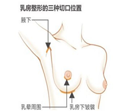 上海乳房下垂矫正的切口明显吗