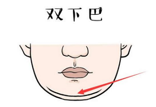 面部双下巴吸脂优势