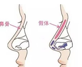 L形假体有可能刺穿