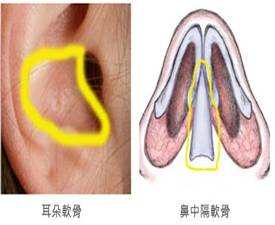 自体软骨隆鼻的方法