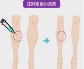 美容外科瘦腿