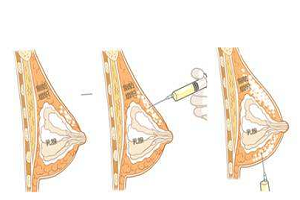 丰胸都有什么优缺点