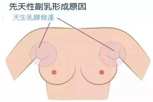 副乳危害健康