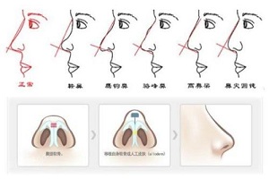 鼻尖整形手术需要多少钱呢