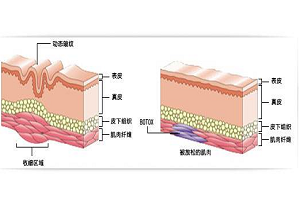 塑形术除皱优点是哪些呢