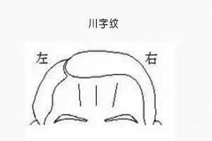 川字纹该怎么去除呢