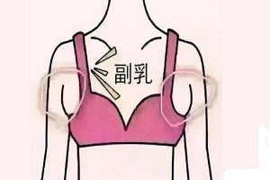 副乳整形都有什么方法