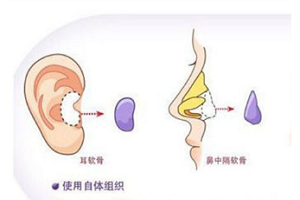 自体软骨隆鼻术后应注意哪些问题