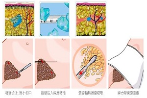 吸脂减肥你最关心那几点呢