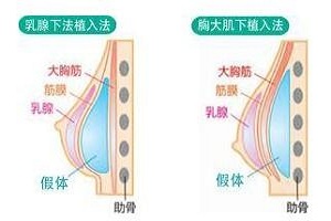 我们该如何选择隆胸假体呢