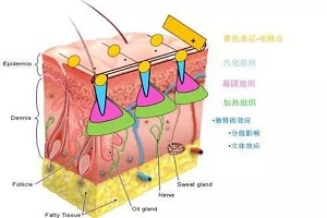 激光去鱼尾纹优点