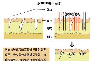 激光除皱手术的优势