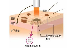 激光祛斑后需要注意些什么吗