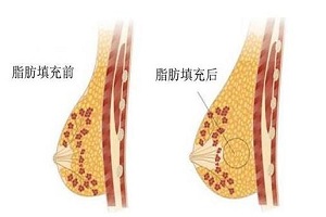 自体脂肪丰胸术价格受什么因素影响